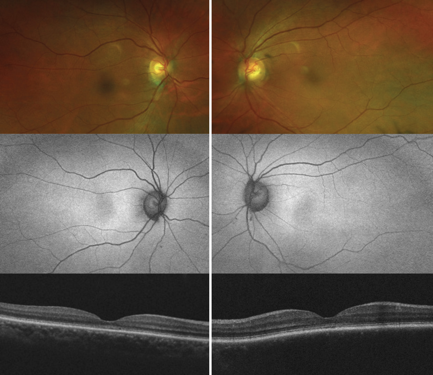 A Case Series Of Occult Macular Dystrophy 